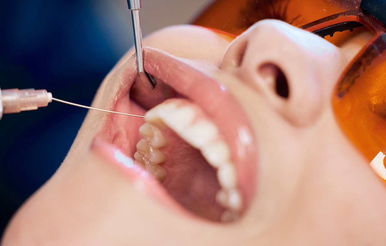 How Long Do Fillings Actually Last? What to Expect Over Time
